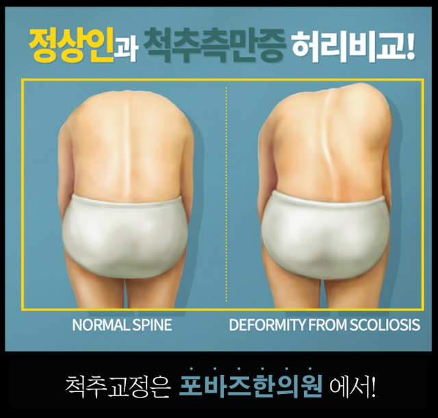 척추교정2.png