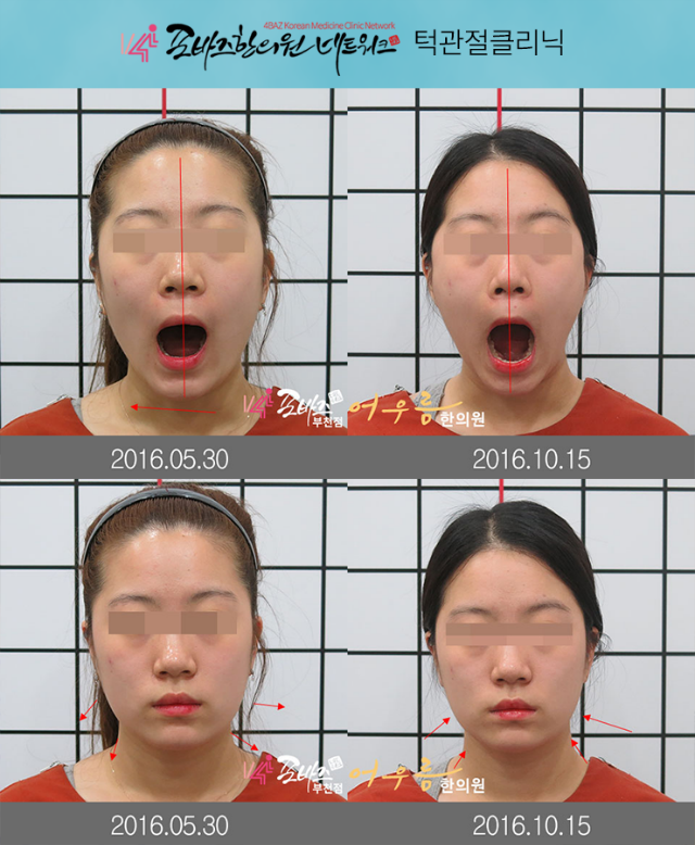 턱관절장애3.png