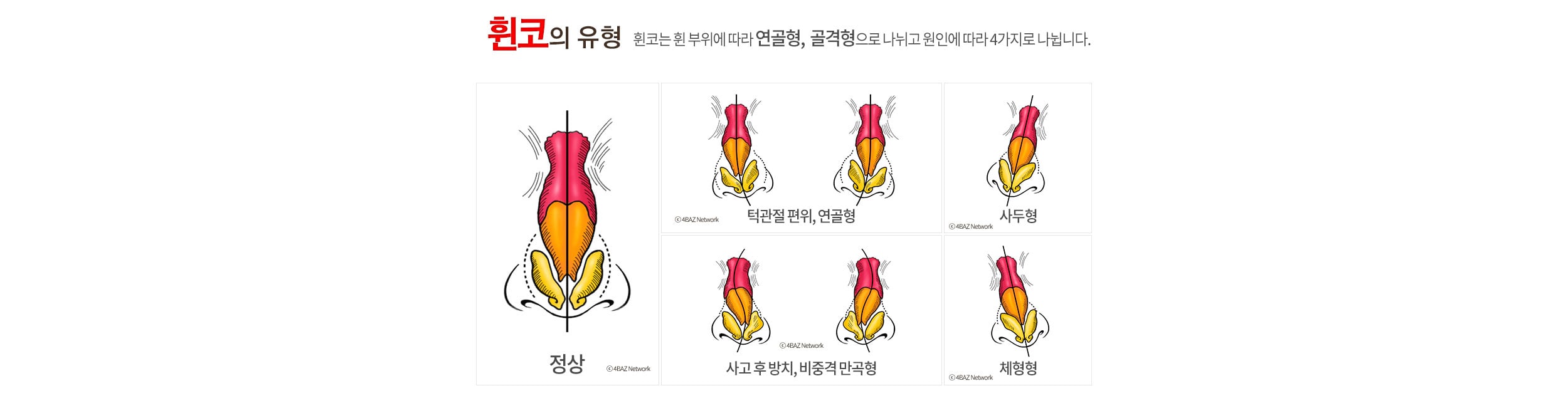 휜코 유형