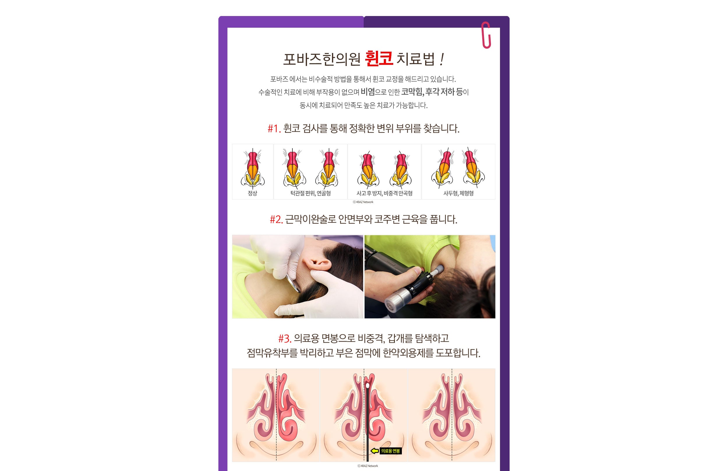 휜코 치료법 - 검사/근막이완술/한외용제