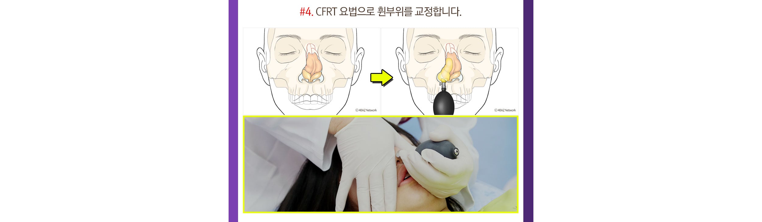 휜코 치료법 - CFRT