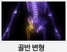 골반 변형