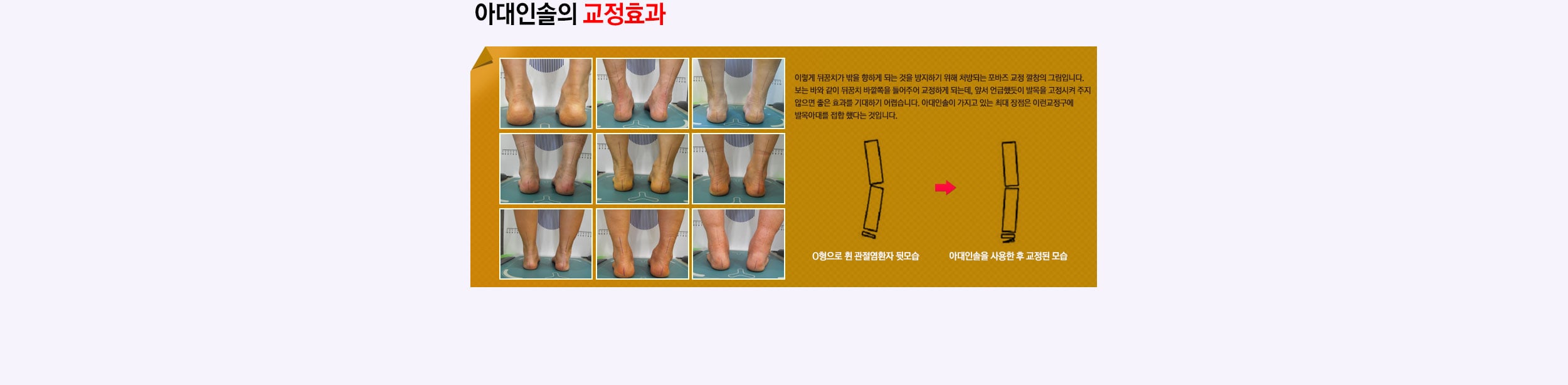아대인솔 치료 전후사진